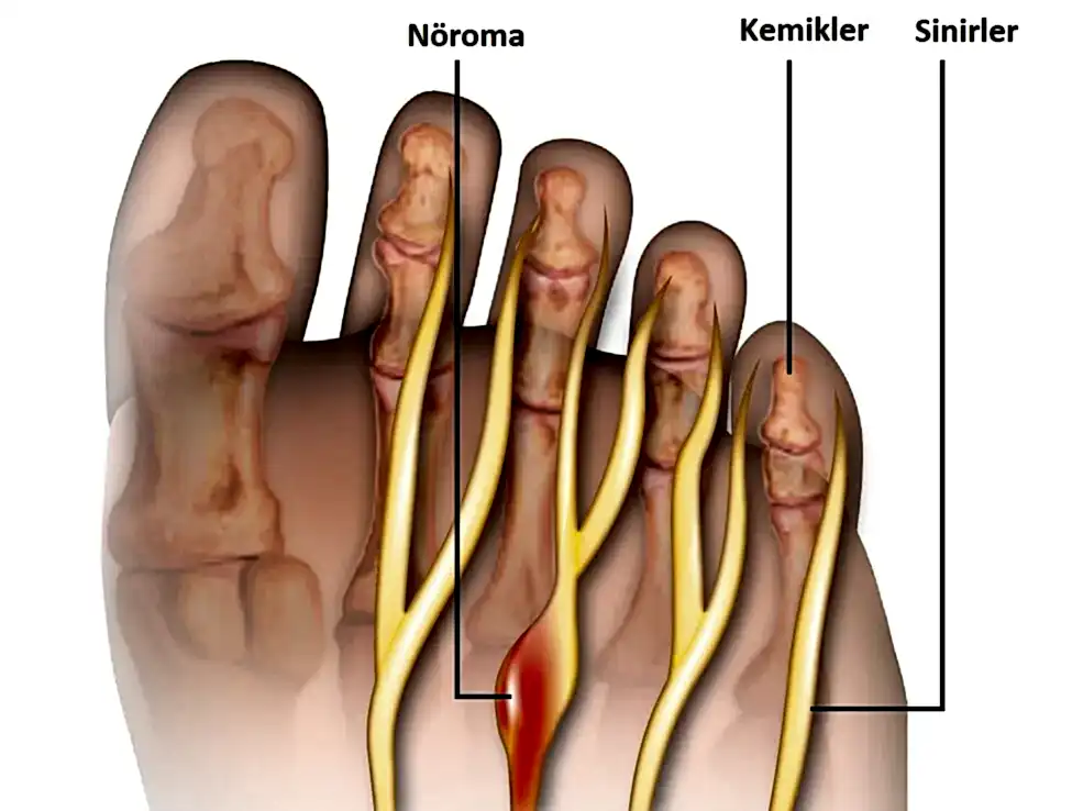 Kayak ve Morton Nöroma, ayaklarda ağrı, yanma ve uyuşma